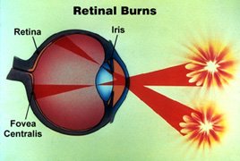 Retinal burn resulting in permanent damage from scarring results when fireball directly viewed