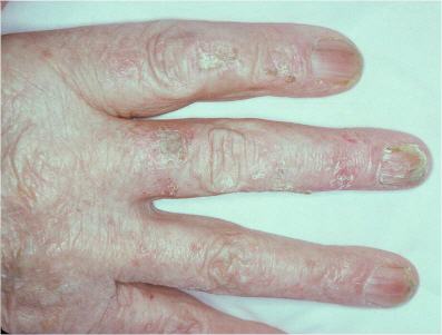 Clinical photo showing chronic dermatitis