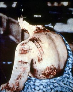 Thermal skin burns: Example after nuclear blast