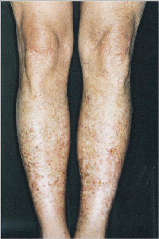 Clinical photo showing lentiginous changes