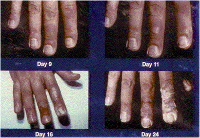 Evolution of skin radiation effects, Day 9 - 24 