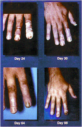 Evolution of skin radiation effects, Day 24 - 96