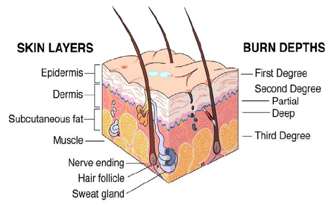 Illustration of skin anatomy and levels of burn injury