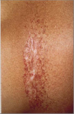 Clinical photo showing telangiectases and epidermal atrophy