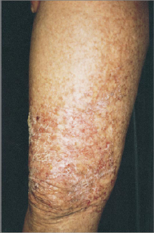 Clinical photo showing telangiectases and xerosis